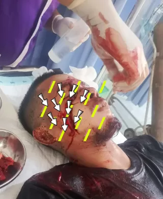 Sakit Hati! Pria di Inhu Bacok Wajah Tetangga Pakai Parang