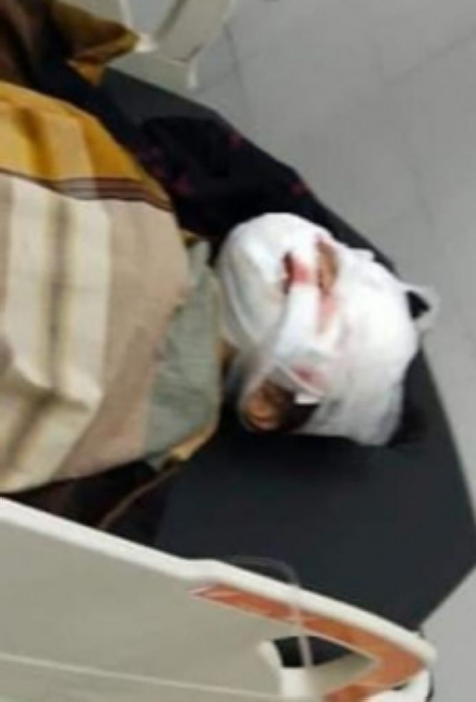  Bocah 8 Tahun di Medan Kritis Diserang Anjing Pit Bull Peliharaan Keluarga